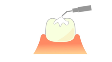 小児歯科　シーラント　予防歯科