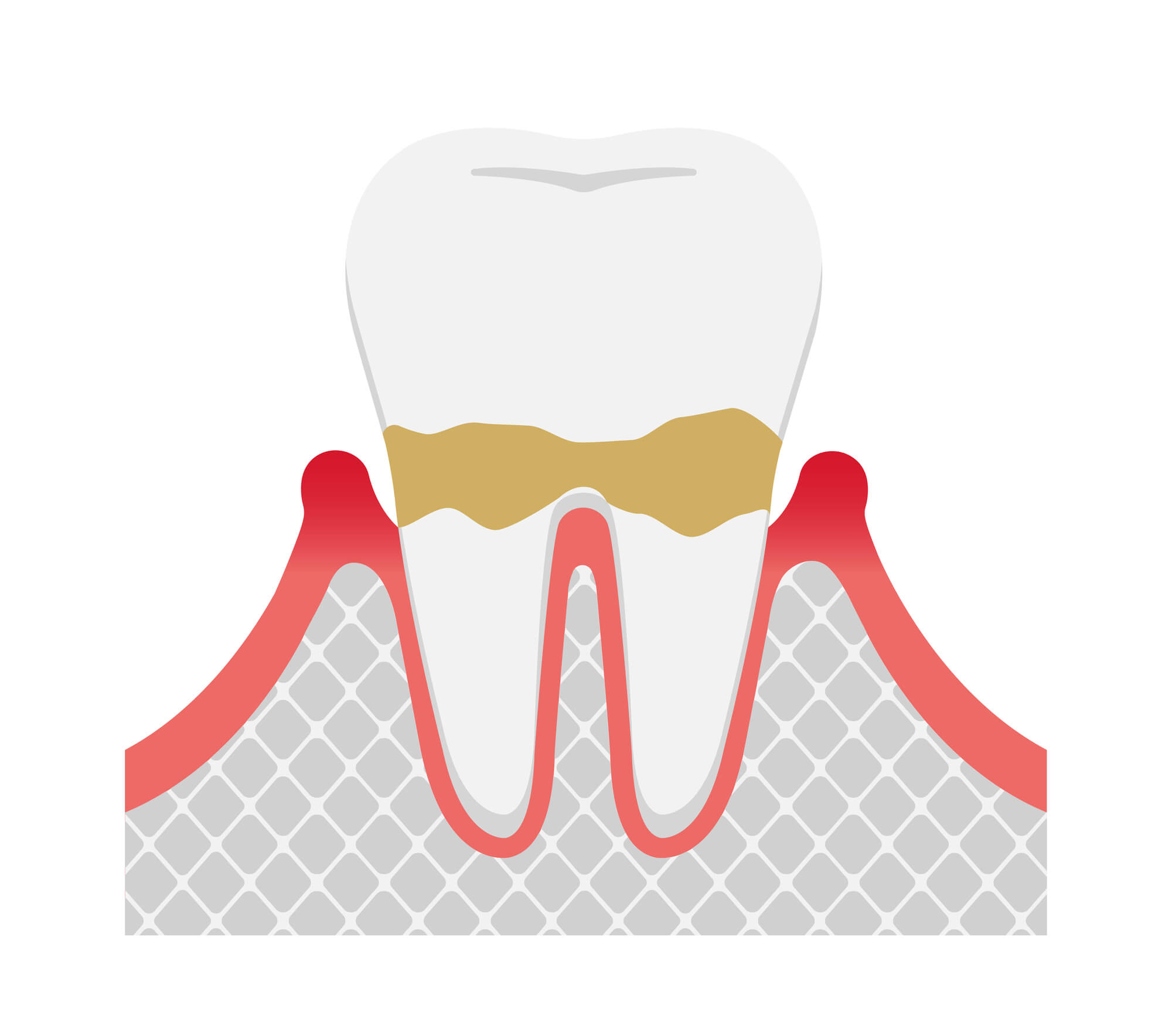 歯周病の進行度合い